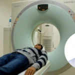 Greater Manchester Lung Screening Cuts Late Cancer 22%